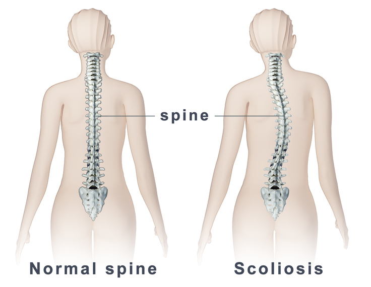 Scoliosis Treatment in Pune