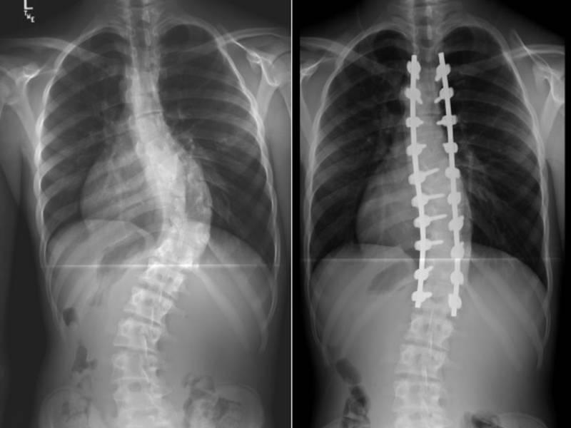 Spinal Deformity Treatment in Pune