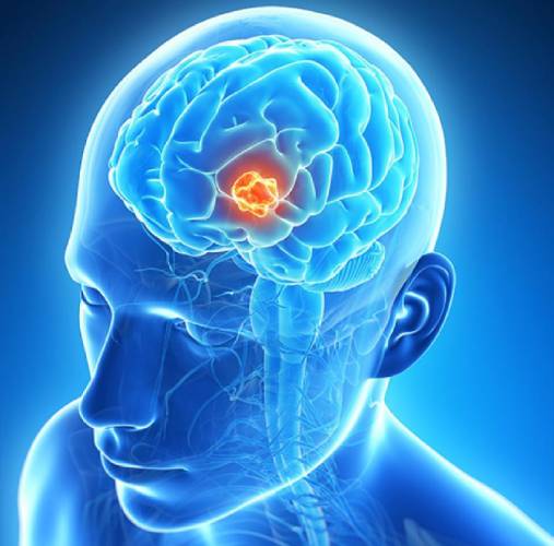 Brain Tumor Surgery in Pune