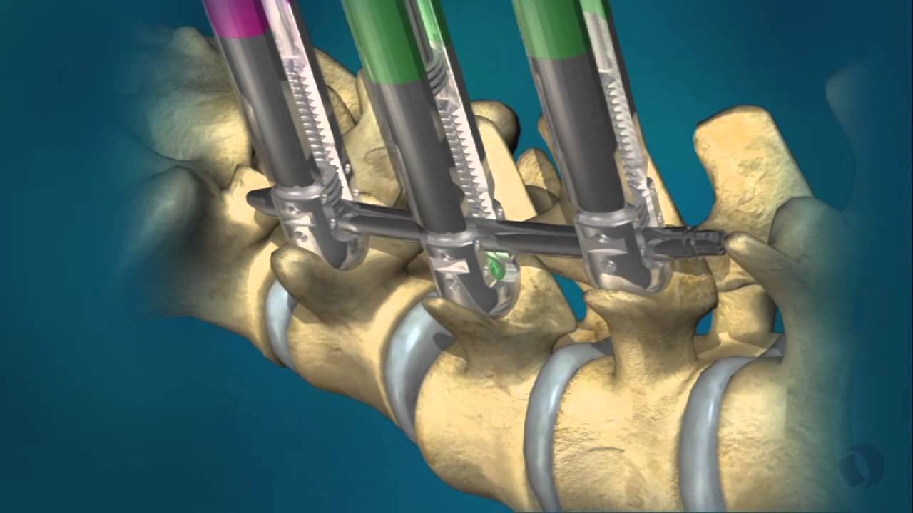 Percutaneous Screw Fixation Doctor in Pune