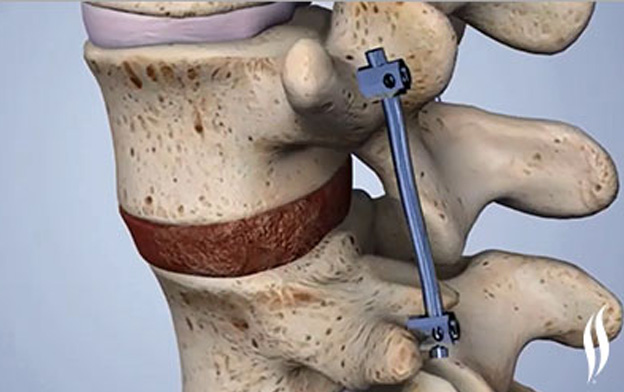 Spinal Fusion Surgery in Pune