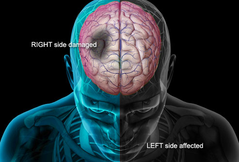 Brain Stroke Treatment in Pune